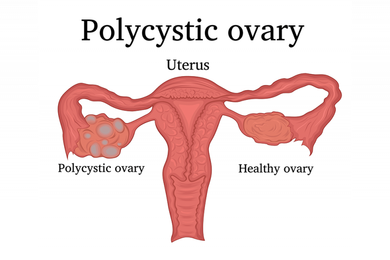7 Signs You Might Have Polycystic Ovarian Syndrome Queensland Health