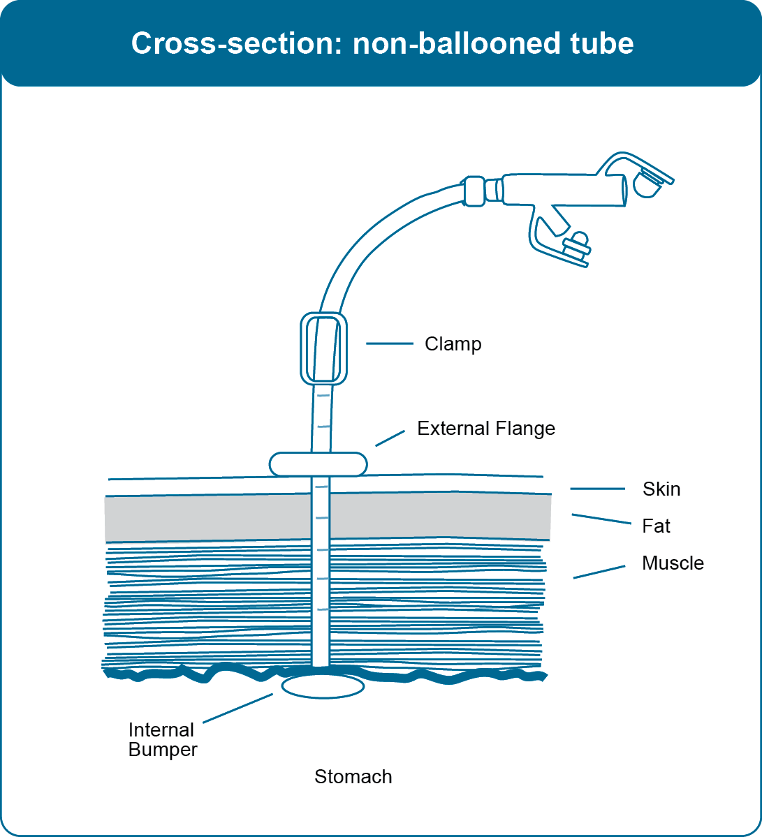 Diagram of cross-section, non-ballooned gastrostomy tube