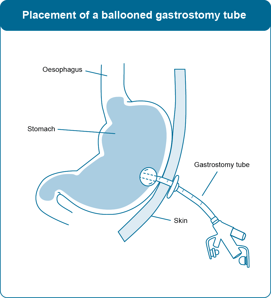 Diagram of placement for a ballooned gastrostomy tube