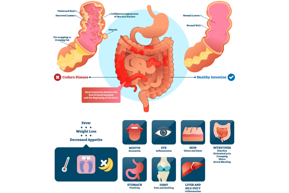 Coeliac vs Crohn's—what's the difference? | Queensland Health